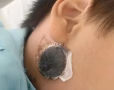 Nguy kịch do viêm não vì điều trị quai bị tại nhà