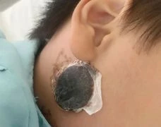 Nguy kịch do viêm não vì điều trị quai bị tại nhà