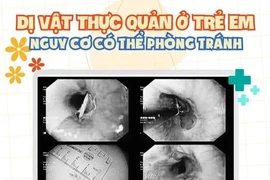 Dị vật thực quản trẻ em: Nguy hiểm có thể phòng tránh