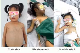 Ca ghép gan đặc biệt cho bệnh nhi có bất thường về mạch máu hiếm gặp