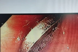 Bé 6 tuổi nuốt đồng xu chơi game vào thực quản