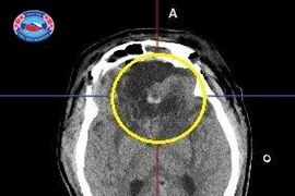Định vị thần kinh lấy trọn khối u màng não nền sọ kích thước khổng lồ