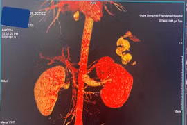 Nút mạch cầm máu cứu học sinh bị bạn đâm thủng thận trong gang tấc