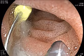 Đi chữa răng trẻ 5 tuổi nuốt cả cây kim 2,5 cm vào bụng