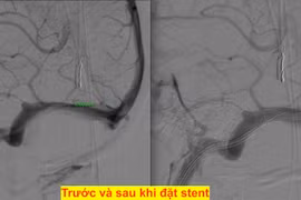 Nữ bệnh nhân lần đầu có giấc ngủ ngon sau 14 năm đau đầu, ù tai