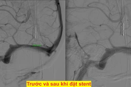 Nữ bệnh nhân lần đầu có giấc ngủ ngon sau 14 năm đau đầu, ù tai