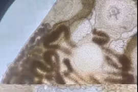 Nội soi phát hiện sán lá ruột nhỏ trong đại tràng bệnh nhân