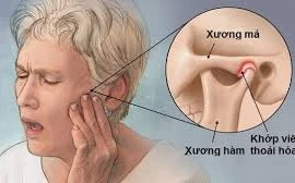 Địa chỉ vàng: Nơi khám chữa viêm khớp thái dương hàm tốt