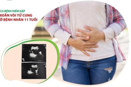 Hiếm gặp trường hợp xoắn vòi tử cung ở bệnh nhân 11 tuổi