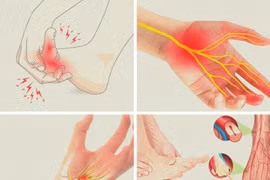 Bác sĩ mách cách khắc phục các bệnh gây tê bì chân tay