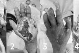 Từ vết ngứa nhỏ, người phụ nữ bị hoại tử, phải tháo ngón tay