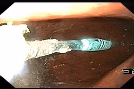 Bàn chải đánh răng trong dạ dày bệnh nhân