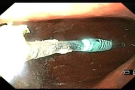 Bàn chải đánh răng trong dạ dày bệnh nhân