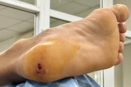 Từ vết thương nhỏ, 10 trường hợp nguy kịch vì uốn ván