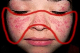 Bác sĩ chỉ cách chung sống với bệnh lupus ban đỏ?