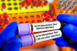 Xét nghiệm phát hiện suy tuyến thượng thận do điều trị Corticoid kéo dài