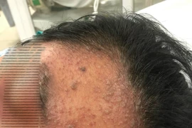 Cô gái 17 tuổi mê sảng, suy đa cơ quan do mắc thủy đậu