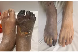 Địa chỉ vàng: Bệnh viện chữa trị thiếu máu chi dưới mạn tính