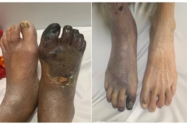 Địa chỉ vàng: Bệnh viện chữa trị thiếu máu chi dưới mạn tính