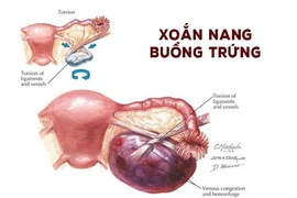 Đau bụng, thiếu nữ 18 tuổi bị u nang buồng trứng xoắn đe dọa tính mạng