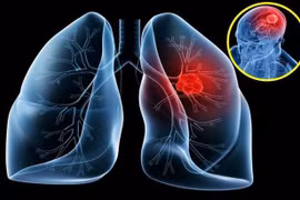 80% bệnh nhân ung thư phổi phát hiện muộn, dự phòng cách nào?