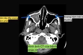 Cẩn thận nấm xoang phá hủy hốc mắt, gây viêm não