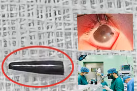 Bé 9 tháng tuổi bị ruột bút chì xuyên thủng nhãn cầu