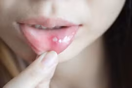 Bác sĩ mách cách phòng chống nhiệt miệng đơn giản