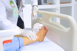 Ngâm chân nước nóng, người phụ nữ bị hoại tử phải tháo khớp ngón