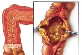 Tự ý dùng kháng sinh cụ bà 81 tuổi bị suy thận, viêm đại tràng nặng