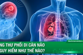 Ung thư phổi di căn não nguy hiểm như thế nào?