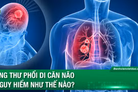 Ung thư phổi di căn não nguy hiểm như thế nào?