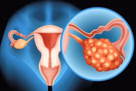 Dấu hiệu ung thư buồng trứng không nên bỏ qua