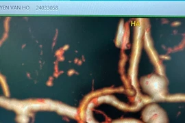 Hoa mắt ngã quỵ người đàn ông hôn mê vì vỡ túi phình mạch máu lớn