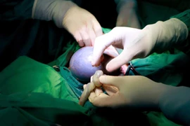 Hai bé song sinh chào đời, 1 bé trong "bọc điều" hiếm gặp