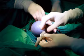 Hai bé song sinh chào đời, 1 bé trong "bọc điều" hiếm gặp