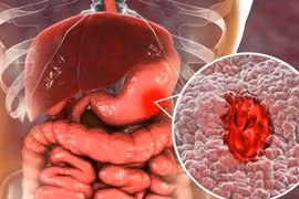 Ung thư dạ dày liên quan đến HP do ăn uống không lành mạnh