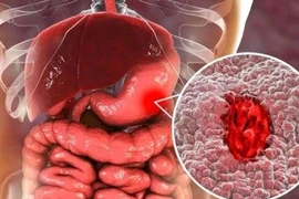 Ung thư dạ dày liên quan đến HP do ăn uống không lành mạnh