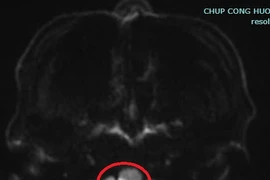 Tưởng chóng mặt vì say rượu... ai ngờ liệt do đột quỵ não