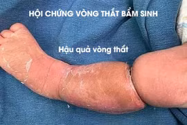 Tưởng bé bụ bẫm có ngấn... nào ngờ mắc hội chứng vòng thắt bẩm sinh