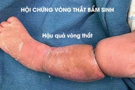 Tưởng bé bụ bẫm có ngấn... nào ngờ mắc hội chứng vòng thắt bẩm sinh