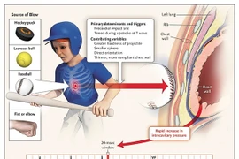 Ngừng tim đột ngột liên quan đến hoạt động thể thao, do đâu?