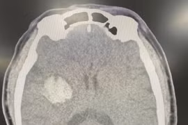 Đột quỵ não nguy kịch do tự uống “an cung ngưu hoàn hoàn”