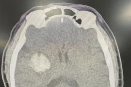 Đột quỵ não nguy kịch do tự uống “an cung ngưu hoàn hoàn”