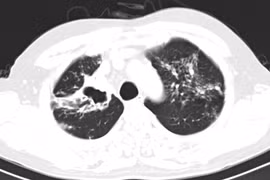 Nhiều trường hợp phát hiện lao phổi nhờ vô tình đi khám sức khỏe định kỳ