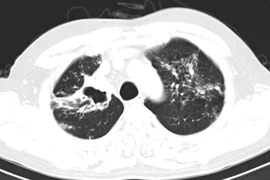 Nhiều trường hợp phát hiện lao phổi nhờ vô tình đi khám sức khỏe định kỳ