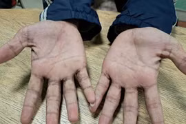 Ngứa da, nổi mụn nước... bất ngờ được chẩn đoán bệnh ghẻ