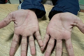 Ngứa da, nổi mụn nước... bất ngờ được chẩn đoán bệnh ghẻ