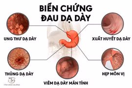 Bác sĩ chỉ rõ yếu tố tăng nguy cơ ung thư dạ dày