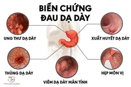 Viêm loét dạ dày - bệnh lý đơn giản nhưng nhiều biến chứng